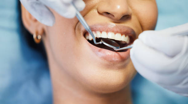 Best Emergency Dental Extractions in Lake Riverside, CA